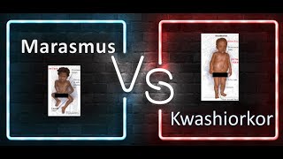 Pediatrics Difference between marasmus and Kwashiorkor PEM Protein energy malnutrition Age Growth [upl. by Hairabez]