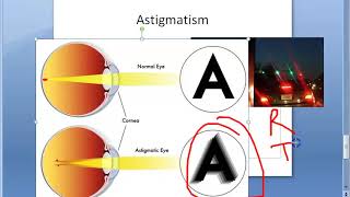 Ophthalmology 044 a Refractive Errors Of Refraction Emmetropia Ametropia Myopia HyperMetropia Eye [upl. by Notgnillew]