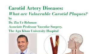 What is Vulnerable Carotid Artery Plaque [upl. by Masao]