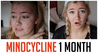 1 MONTH ON MINOCYCLINE UPDATE  HOW I CLEARED MY ACNE [upl. by Kobylak]