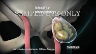 Total Extraperitoneal TEP Laparoscopic Inguinal Hernia Repair [upl. by Carper160]