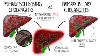 Primary Sclerosing Cholangitis v Primary Biliary Cholangitis Primary Biliary Cirrhosis [upl. by Naie934]