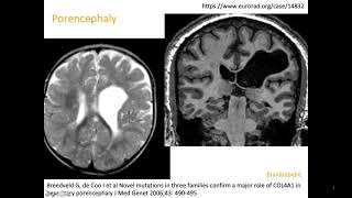 10 Schizencephaly porencephaly COL4A1 mutation congenital CMV open lip closed lip birth defect [upl. by Anetta]