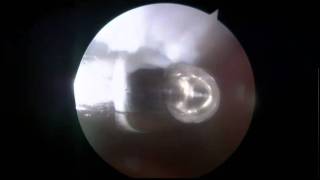 Osteochondritis Dissecans Knee Operation [upl. by Coughlin278]