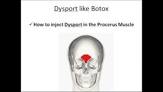 How to inject Dysport in the Procerus Muscle [upl. by Leiad]