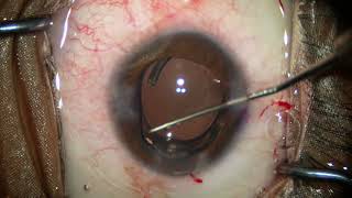 Case of Traumatic cataract with ZD with Traumatic Mydriasis managed with Phaco with pupilloplasty [upl. by Parhe610]