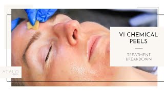 VI Peel Treatment I Chemical Peels [upl. by Nadaha700]