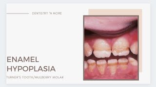 ENAMEL HYPOPLASIATURNERS TOOTH amp MULBERRY MOLARS [upl. by Philbert]