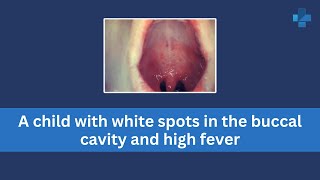 A child with white spots in the buccal cavity and high fever [upl. by Turro]