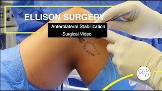 Ellison Technique for anterolateral stabilization in context of ACL reconstruction [upl. by Losse811]