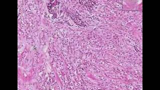 Histopathology BreastLobular carcinoma [upl. by Ynaffets]